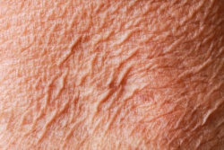 Oudere huid met veranderde vetsamenstelling